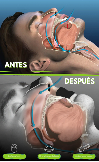 Tiras Nasales ETMN®